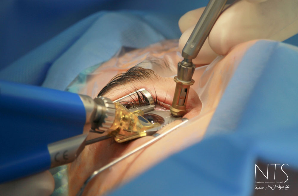 نخ بخیه چشم پزشکی