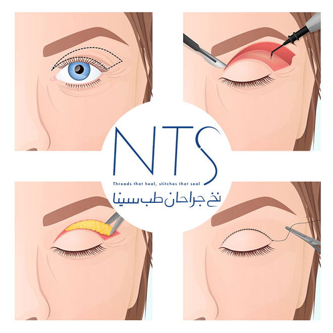 نخ جراحی چشمی