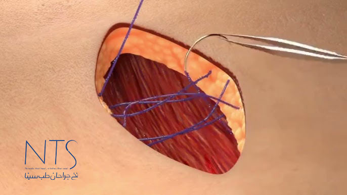 کاربرد نخ جراحی پلی‌ دیاکسانون