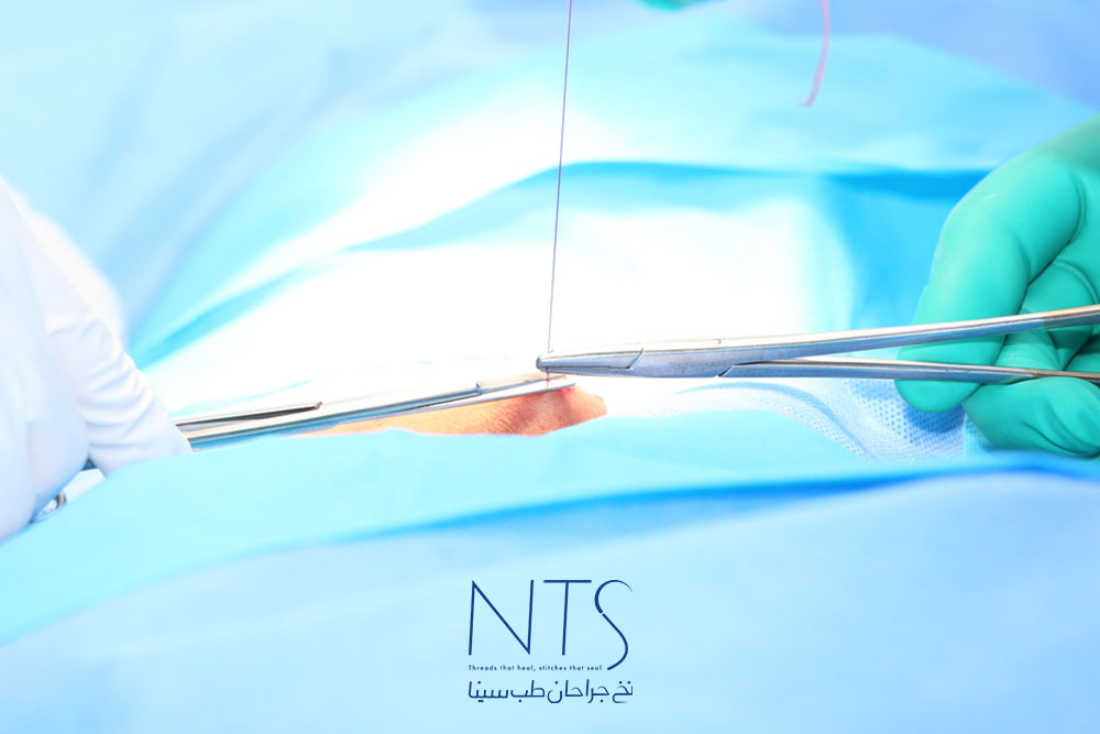 ویژگی نخ بخیه جراحی پلی گلاکتین
