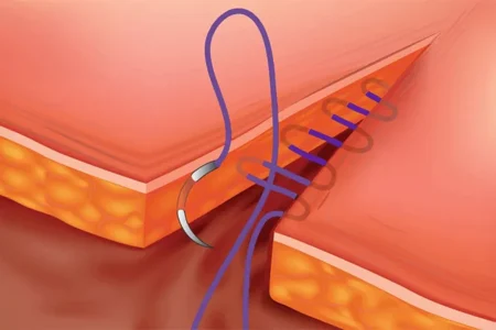 انواع نخ‌ بخیه و کاربرد آن‌ها در عمل‌های جراحی