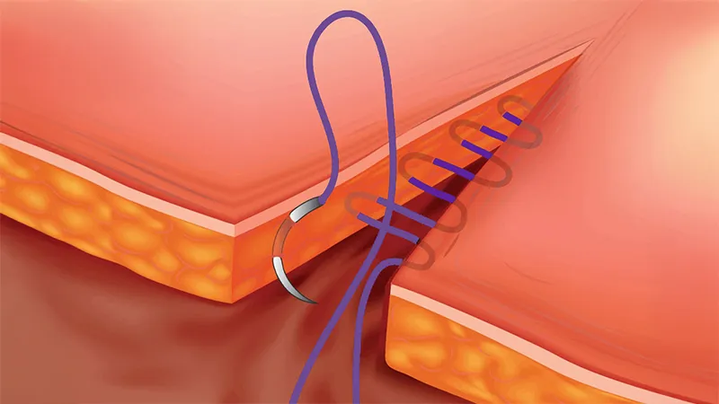 انواع نخ‌ بخیه و کاربرد آن‌ها در عمل‌های جراحی
