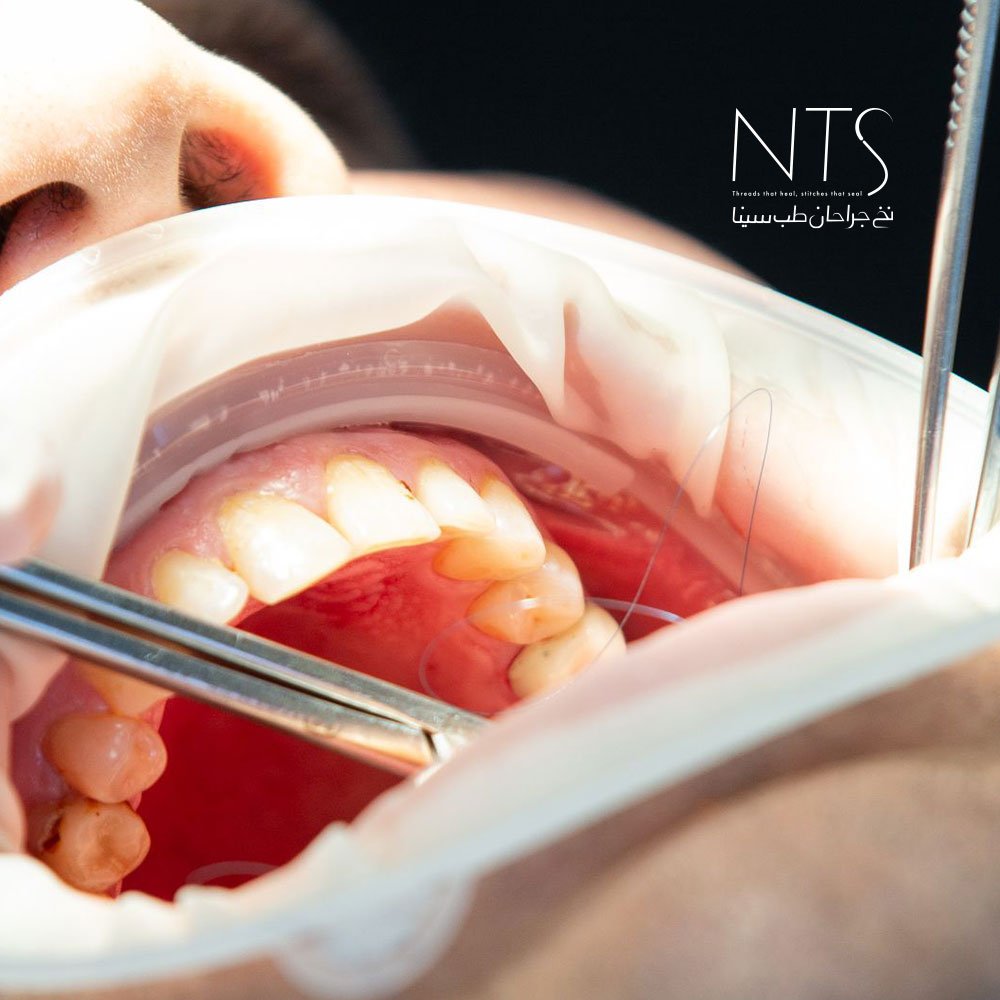 بررسی کاربرد‌های نخ بخیه در دندانپزشکی