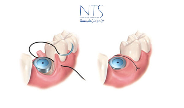 نخ بخیه در دندانپزشکی