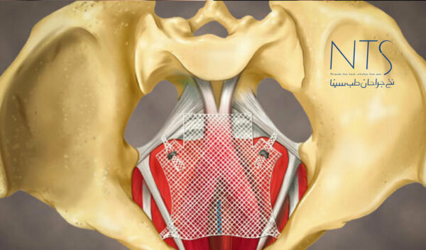 انواع مش جراحی و کاربرد آن