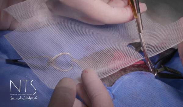 انواع مش جراحی و کاربرد آن