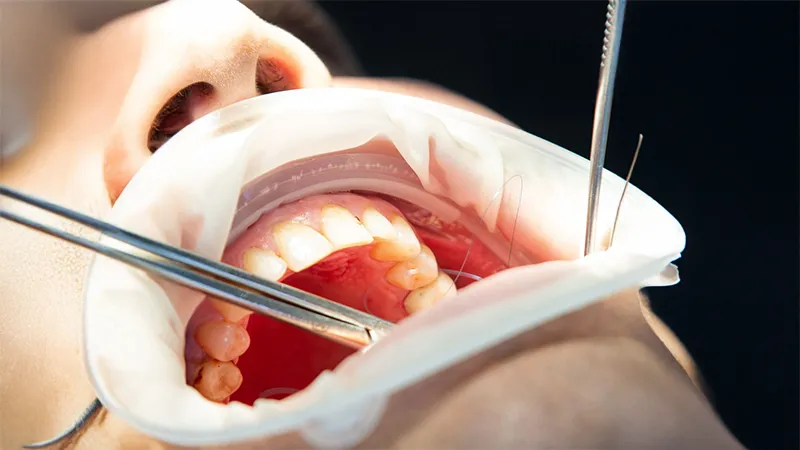 بررسی کاربرد‌های نخ بخیه در دندانپزشکی
