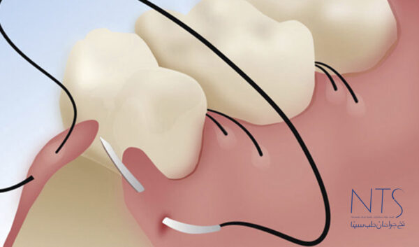 اهمیت بخیه در جراحی‌های دهان و دندان
