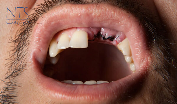 ویژگی‌های نخ بخیه در دندانپزشکی