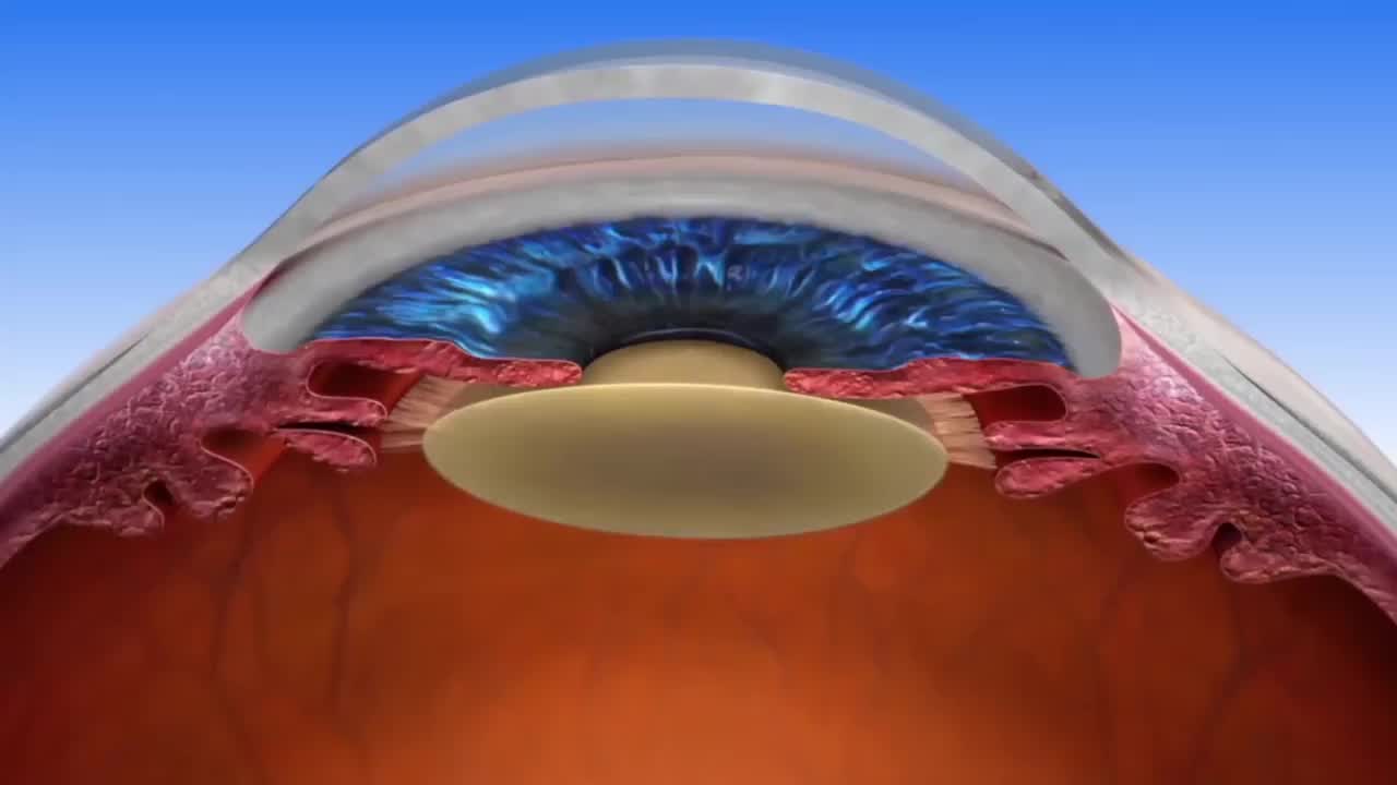 گلوکوم چشم