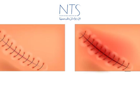 التهاب بعد از بخیه