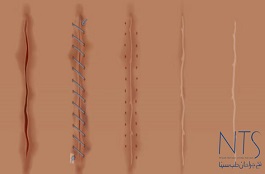 نخ بخیه 11