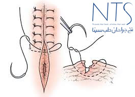 نخ بخیه 13