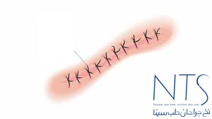 نخ بخیه