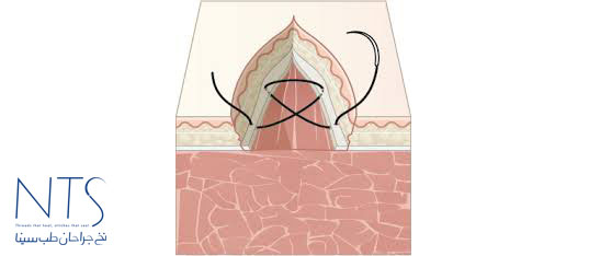 بخیه زنی