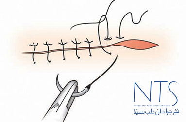 بخیه زنی
