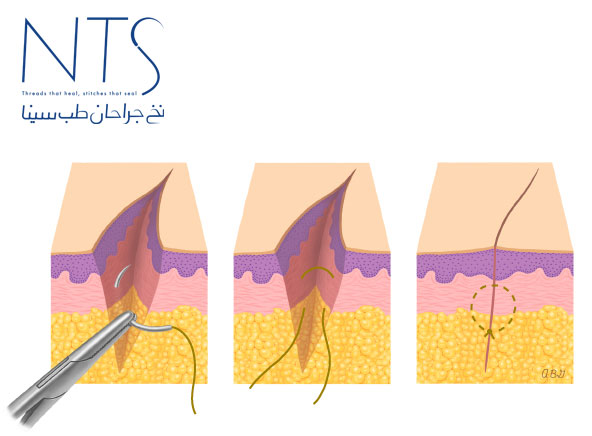 threads suture