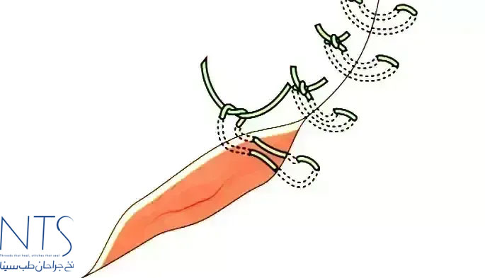 نخ جراحی