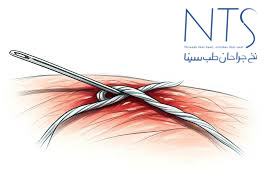 نخ بخیه 3