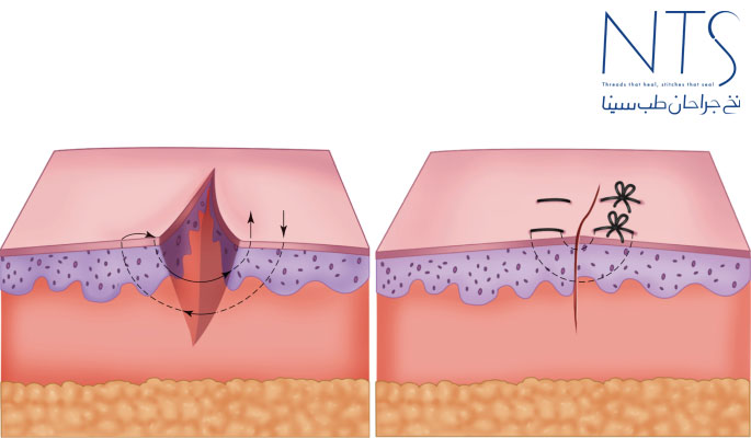 threads suture
