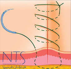 نخ بخیه 5