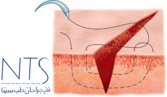 نخ جراحی