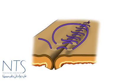 تولید داخلی نخ جراحی