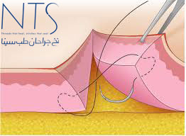 نخ بخیه 6