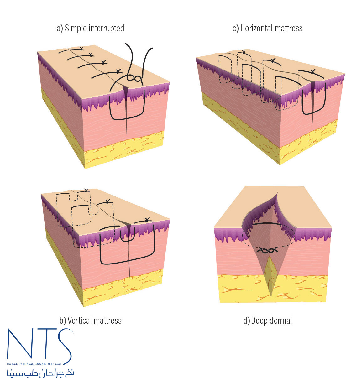 threads suture