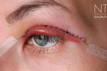 جراحی بلافاروپلاستی