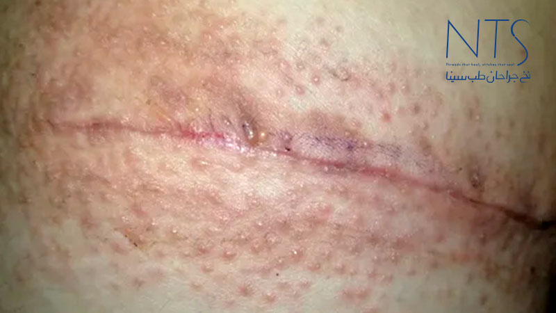 حساسیت به نخ بخیه