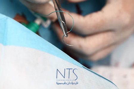 انواع نخ بخیه