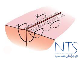 بخیه زنی