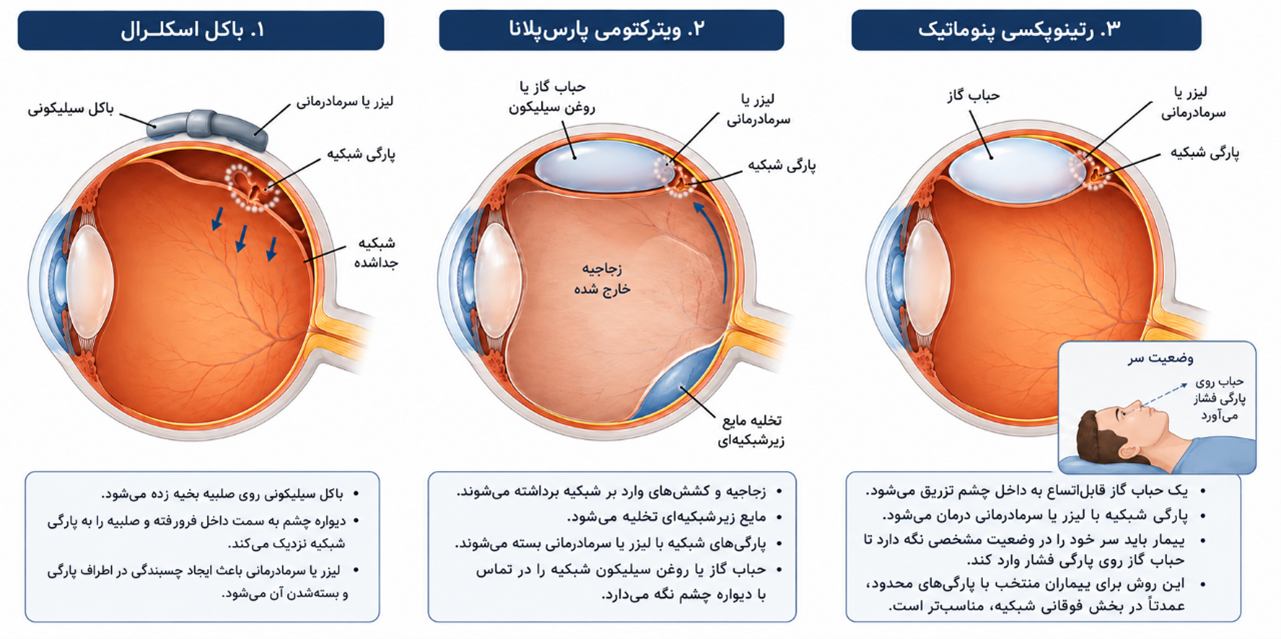 جداشدگیه شبکیه