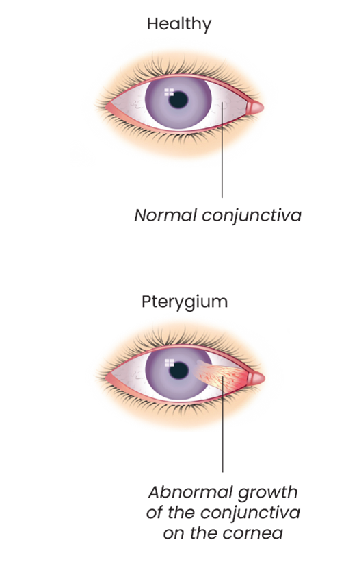 جراحی مجاری اشک (dcr)