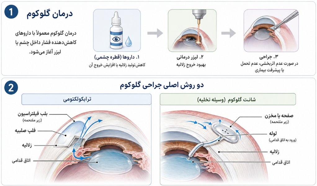جراحی گلوکوم(شانت های گلوکوم، ترابکولیکتومی)