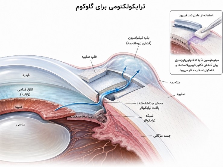 ترابکولیکتومی