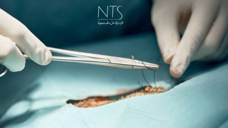 تفاوت نخ بخیه در جراحی‌های داخلی و خارجی