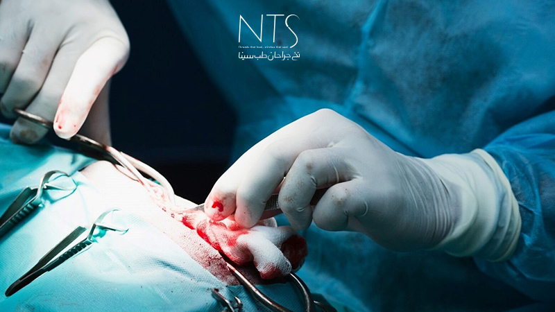 بخیه عمقی