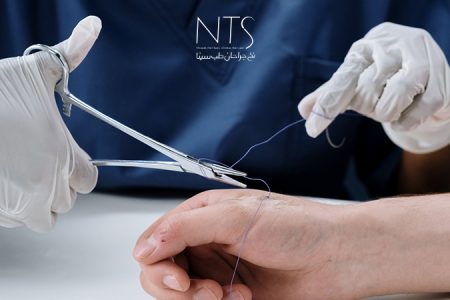 برداشتن بخیه غیرجذبی