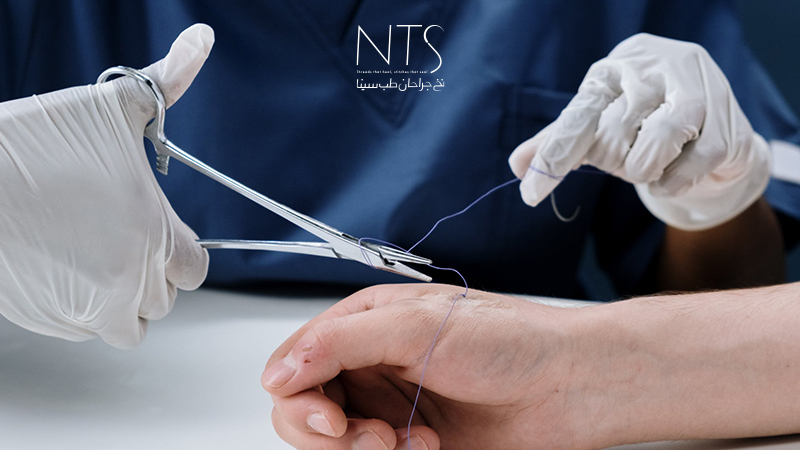 برداشتن بخیه غیرجذبی