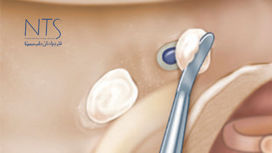 bone wax