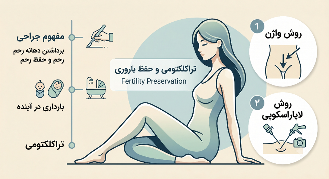تراکلکتومی