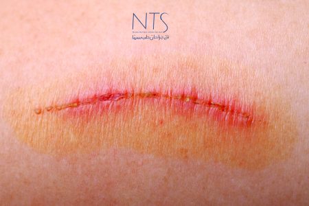 تاثیر نخ بخیه بر ترمیم زخم